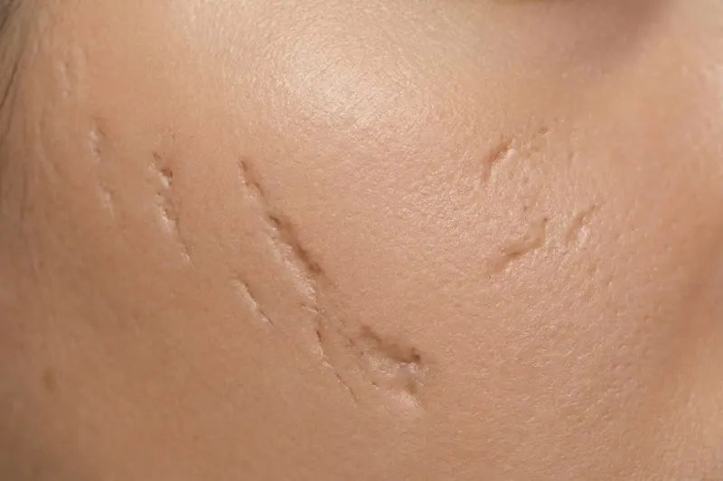 Close-up of skin showing acne scars