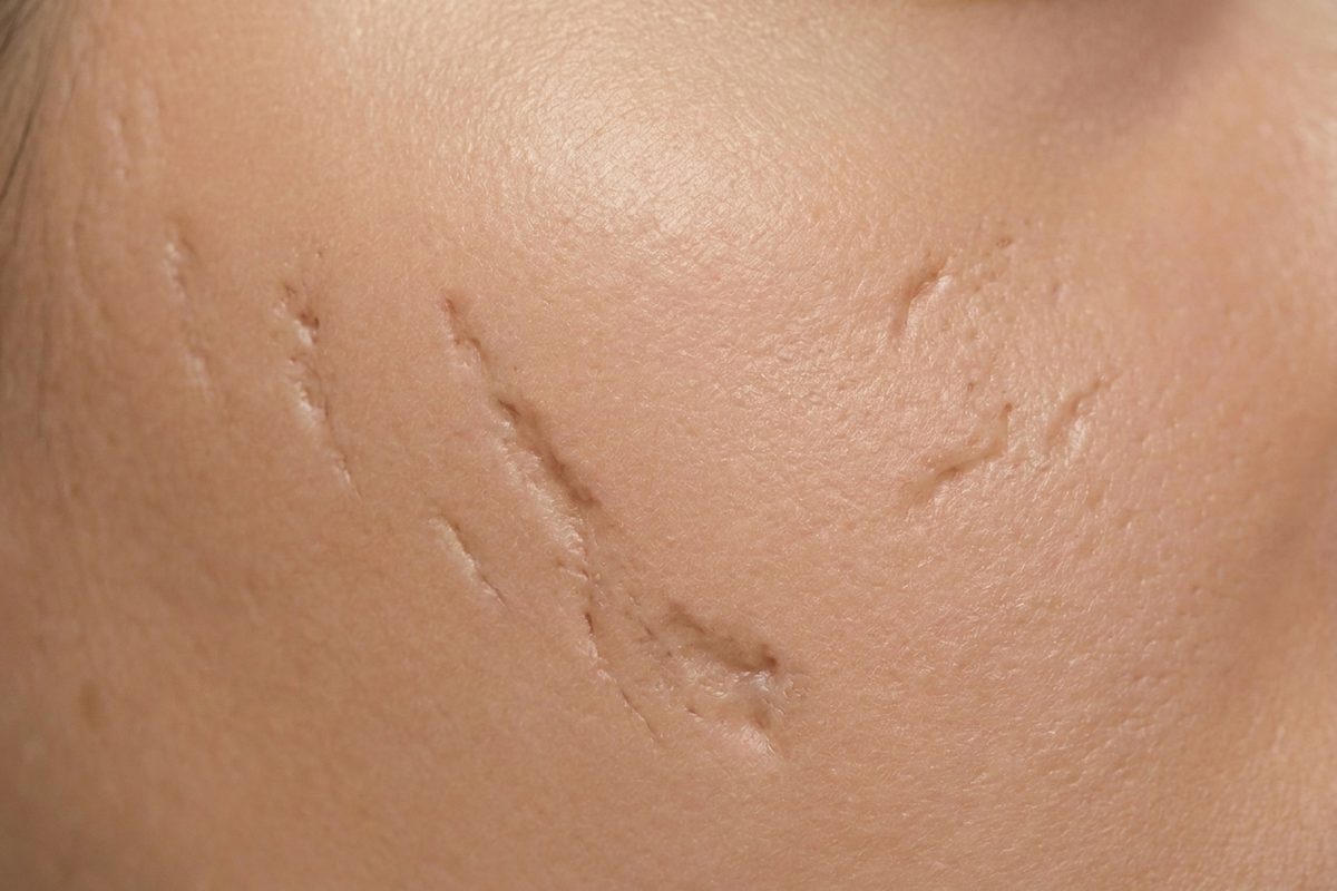 Close-up of skin showing acne scars