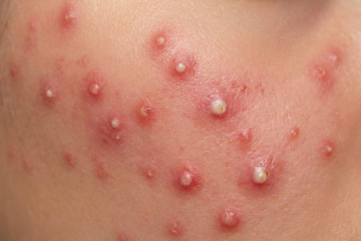 Close-up of skin showing acne