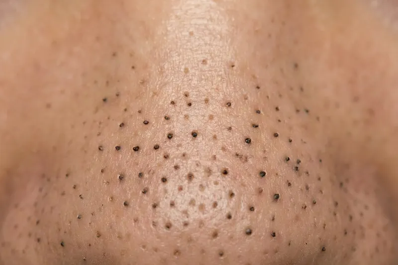 Close-up of skin showing blackheads & whiteheads
