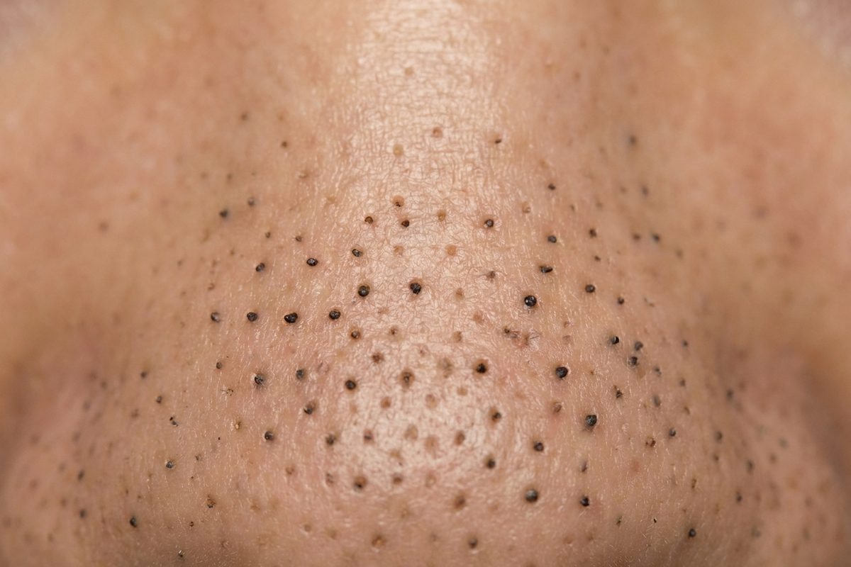 Close-up of skin showing blackheads & whiteheads