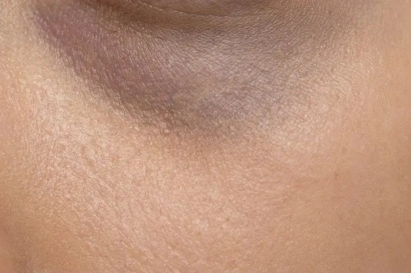 Close-up of skin showing dark circles