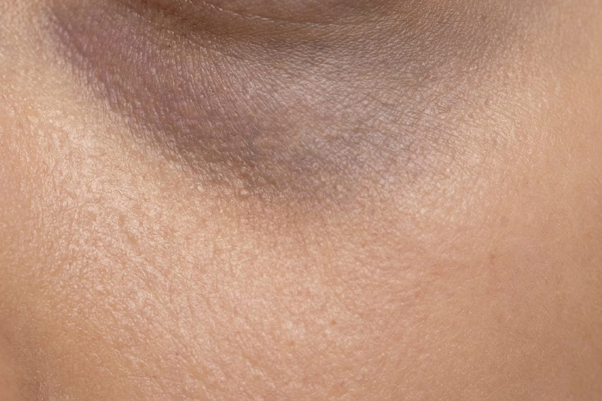 Close-up of skin showing dark circles