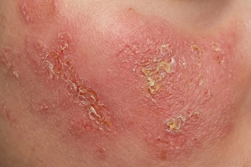 Close-up of skin showing eczema