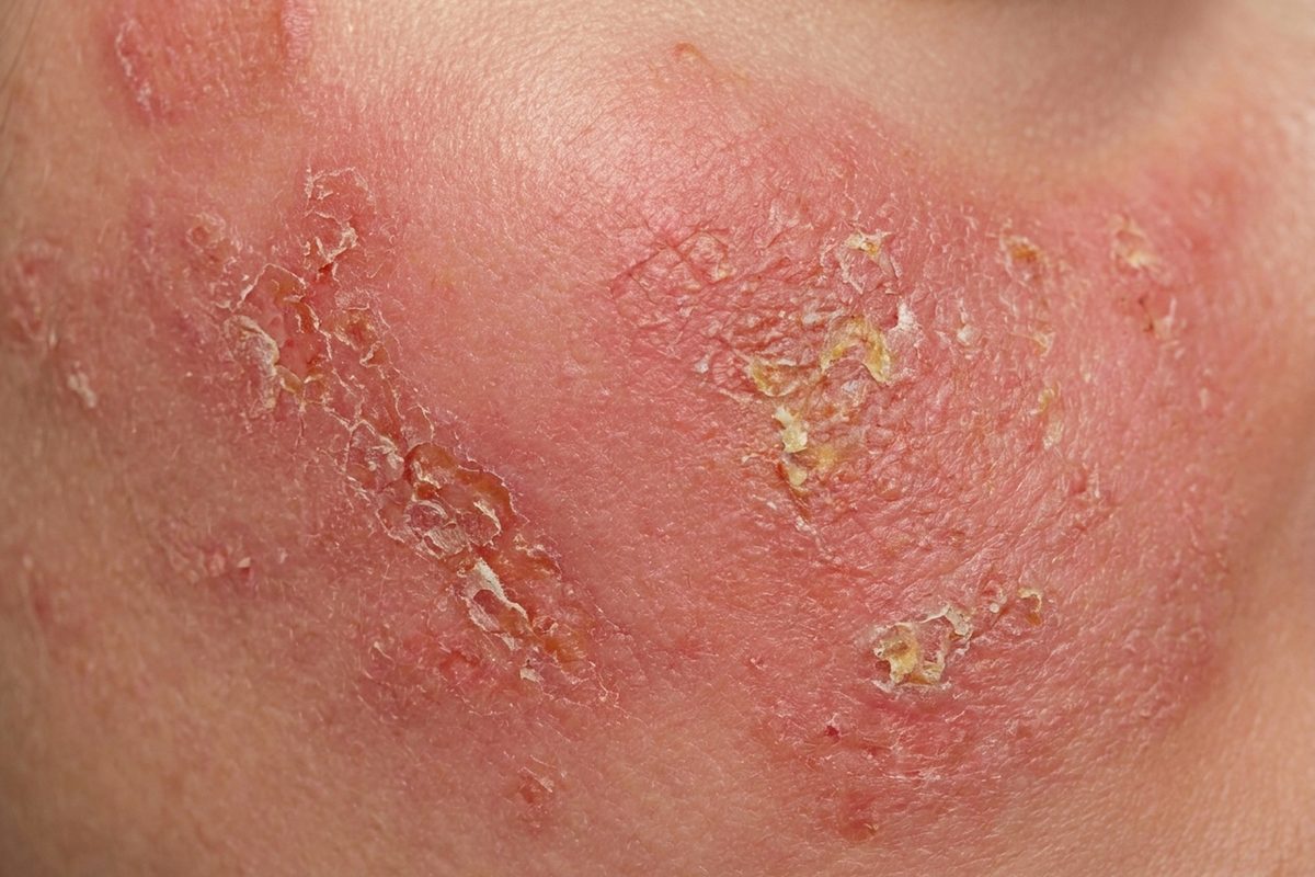 Close-up of skin showing eczema
