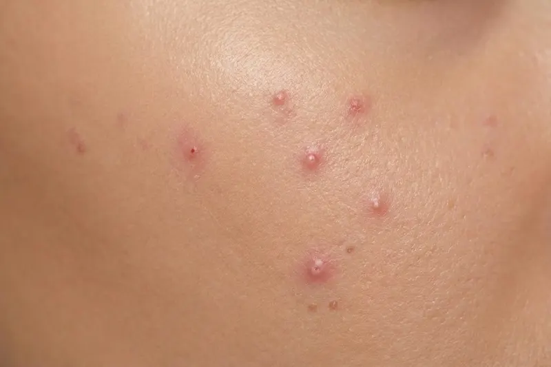 Close-up of skin showing hormonal & cyclical breakouts