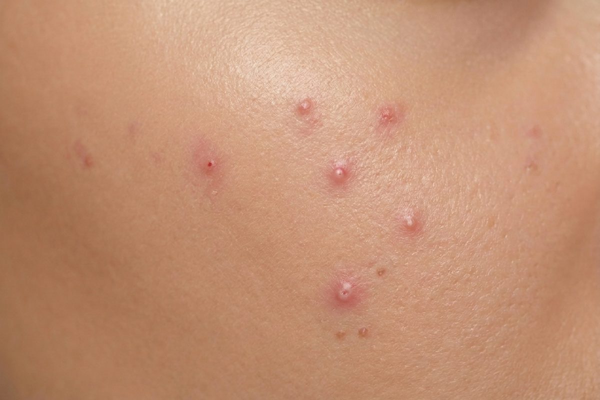 Close-up of skin showing hormonal & cyclical breakouts