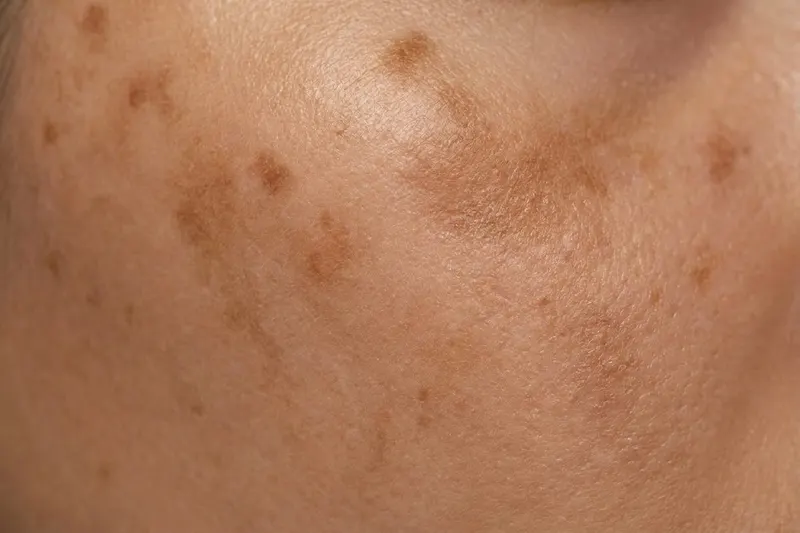 Close-up of skin showing hyperpigmentation