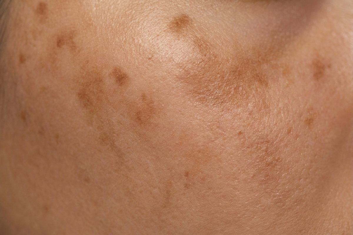 Close-up of skin showing hyperpigmentation