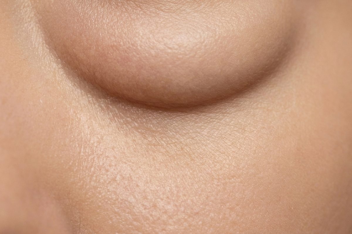 Close-up of skin showing puffiness