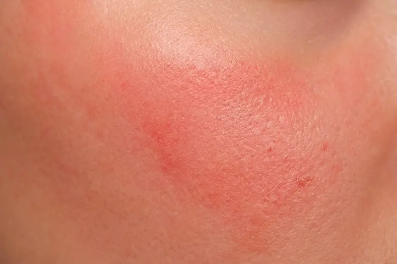 Close-up of skin showing redness