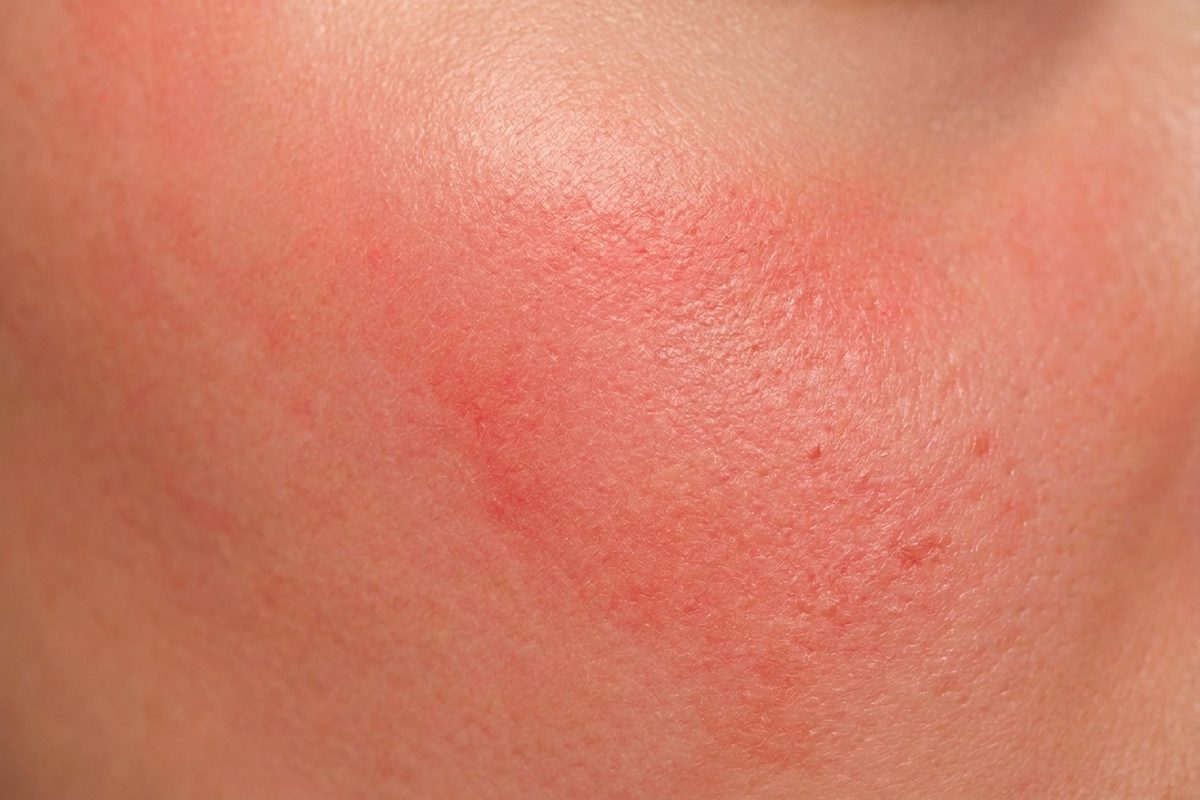 Close-up of skin showing redness