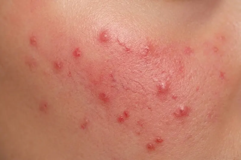 Close-up of skin showing rosacea