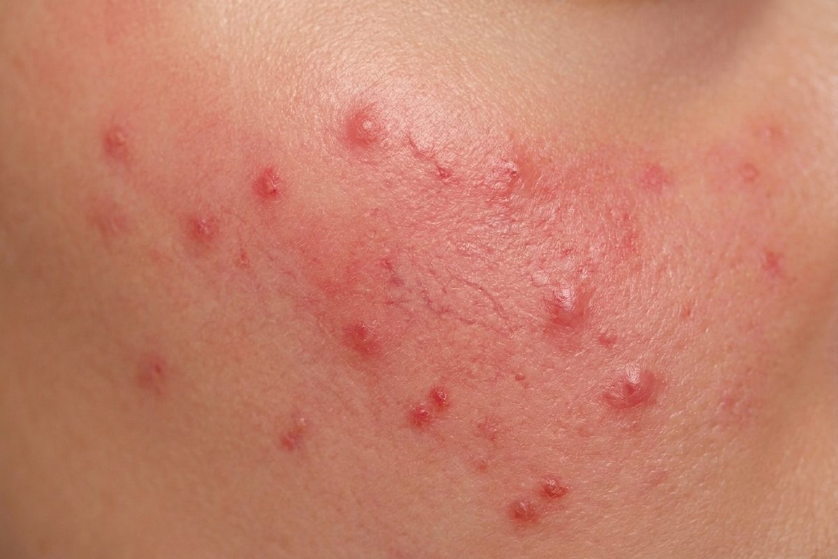 Close-up of skin showing rosacea