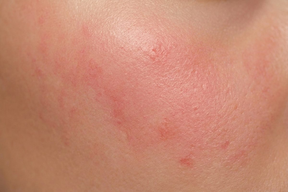 Close-up of skin showing sensitive skin