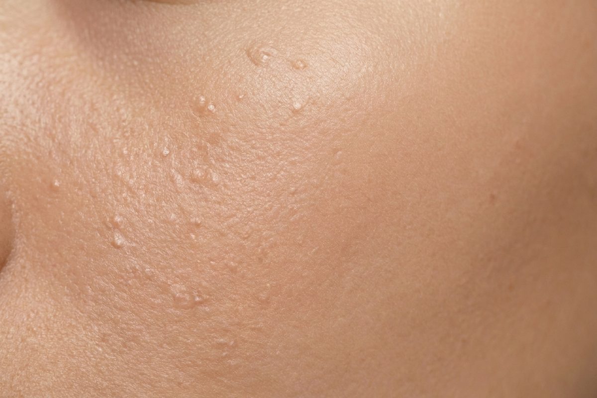 Close-up of skin showing uneven texture
