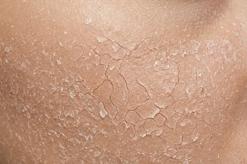 Close-up of skin showing very dry skin